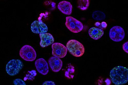 Nei tumori umani sono presenti specifiche comunità batteriche complesse