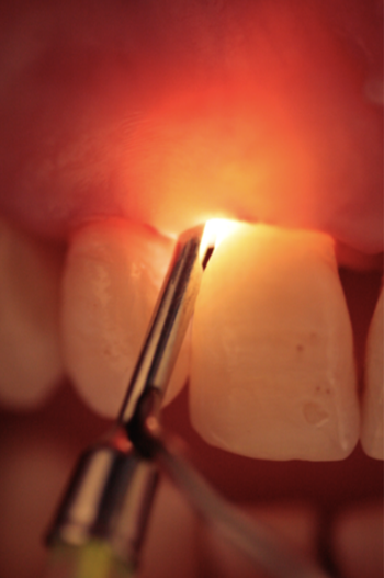 immagine operazione al dente